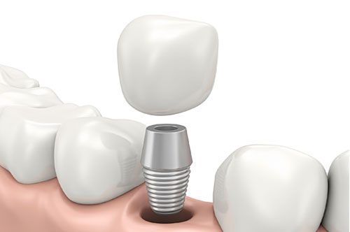 Build A Healthy Smile With Dental Implants (infographic)