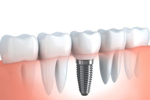 Dental Implants Mean Better Teeth Replacements (video)