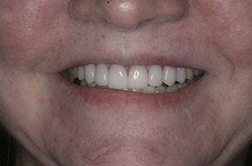 Clevanna-After_Veneers-Crowns-375x230_280wx185h
