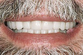 Cooksey-After_Veneers-Crowns-375x230_280wx185h