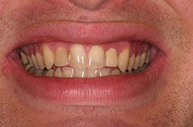 Neely-Before_Whitening-375x230_280wx185h