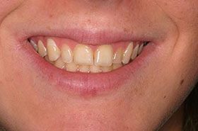 Unk-Before_Whitening-375x230_280wx185h