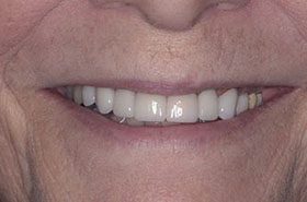 Wallace-After_Veneers-Crowns-375x230_280wx185h
